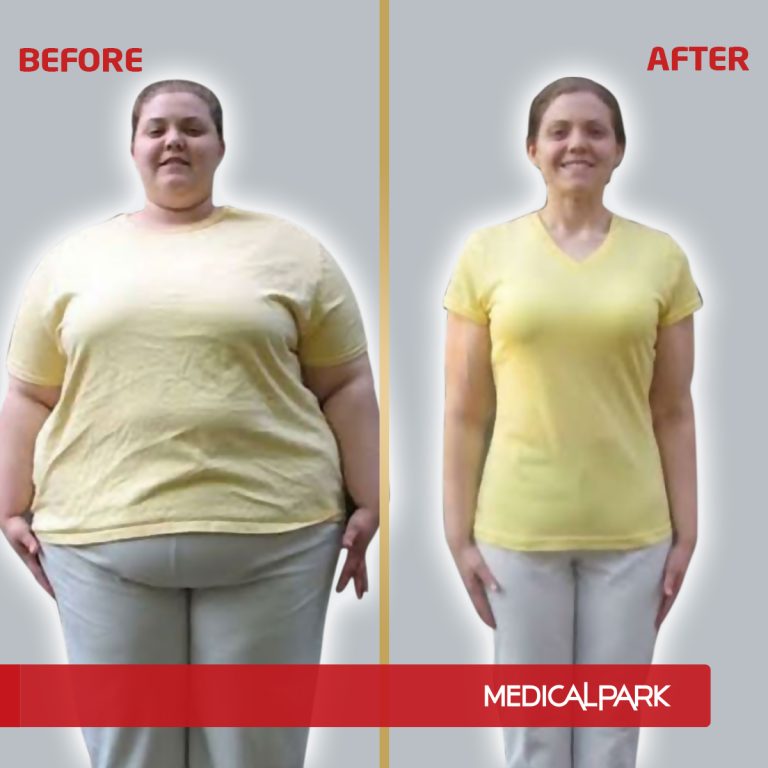 MP_BeforeAfter_Obezite2.jpg