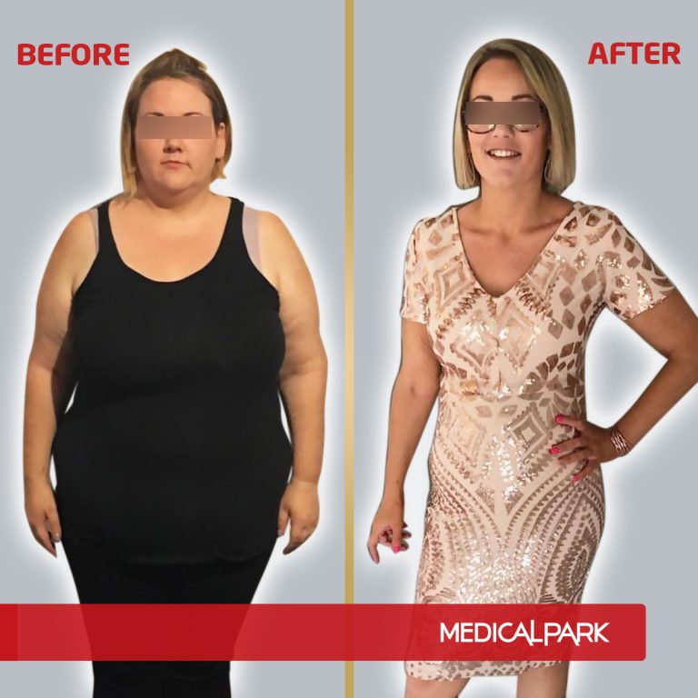 MP_BeforeAfter_Obezite3.jpg