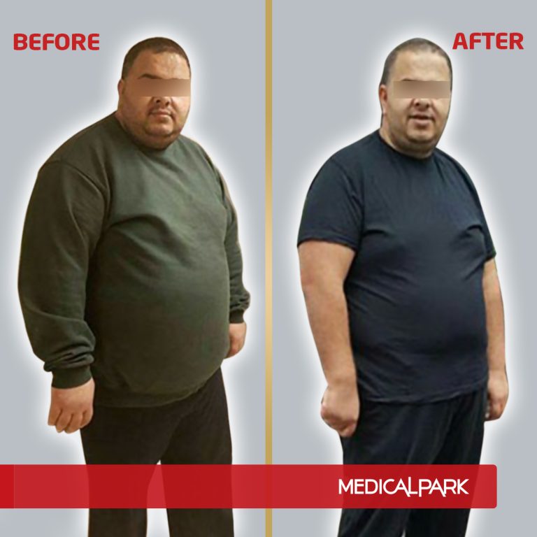 MP_BeforeAfter_Obezite4.jpg